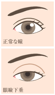 正常な瞳と眼瞼下垂